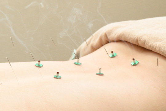 腰背部の鍼灸