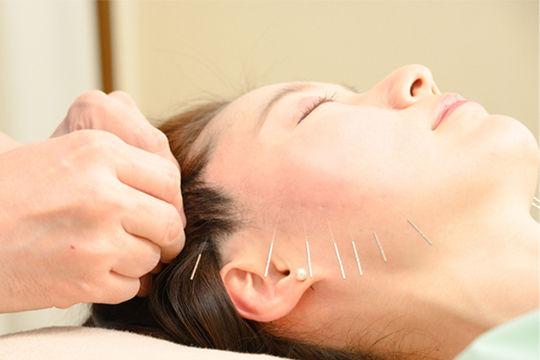 美容鍼施術