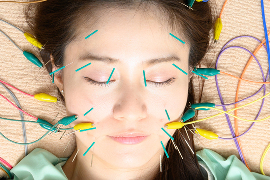 微弱電流美容鍼