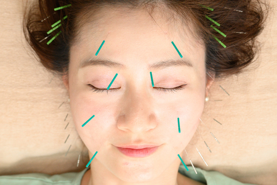 美容鍼施術