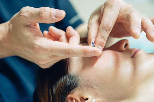 美容鍼と美顔はり