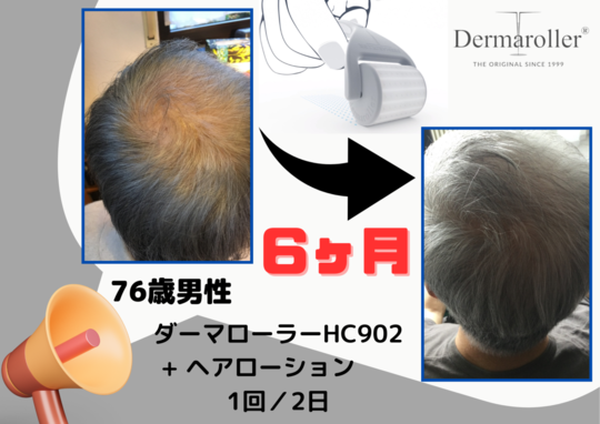 ダーマローラー育毛