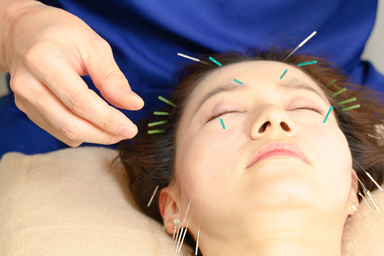 美容鍼施術