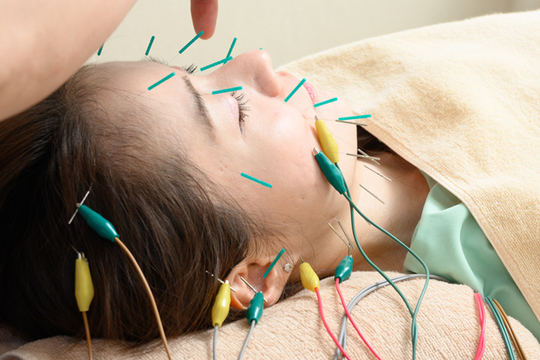 微弱電流美容鍼を受ける女性