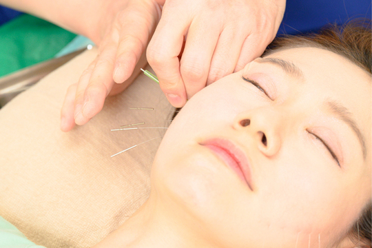 リフトアップ鍼